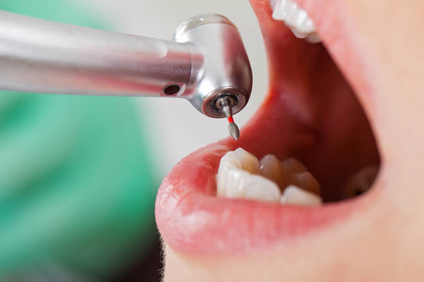 Best Emergency Dentist for Knocked-Out Tooth in Bennettsville, SC